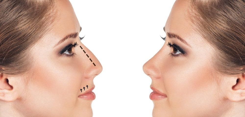 rhinoplastie-2