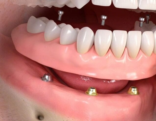 implant-dentaire-1-Copie