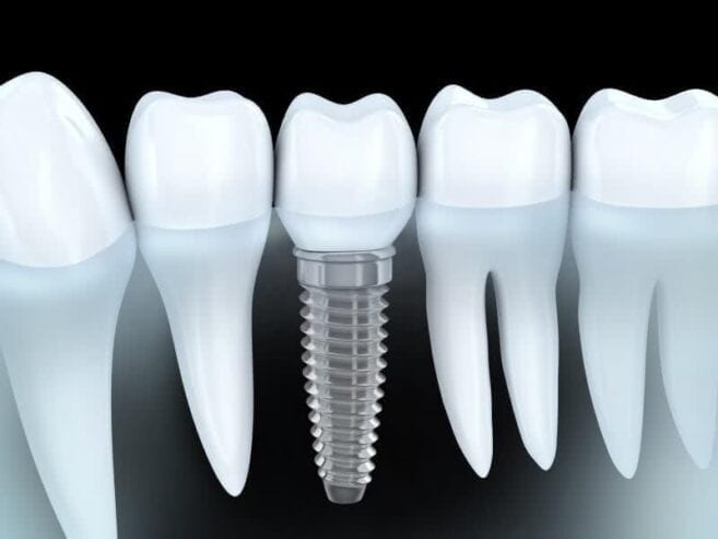 remboursement-implant-dentaire