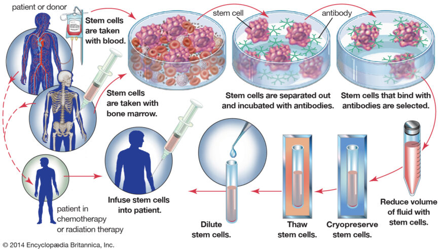 bone-marrow-stem-cells-cancer-radiation-chemotherapy